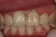 Crack Sealants