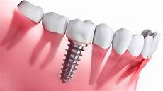 Sealants